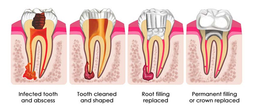 Tooth Filling 1