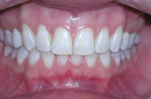 Healthy Gums