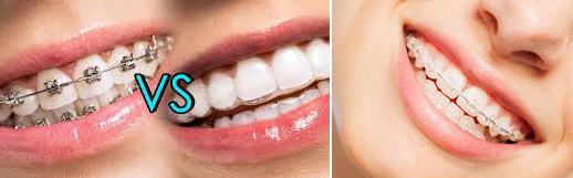 Orthodontics / Braces / Aligners