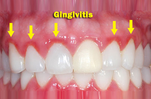 Gum Disease