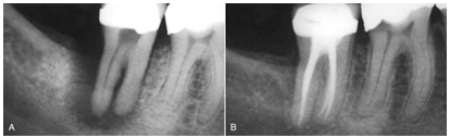 Tooth Filling 2