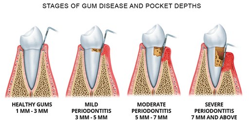 Stages of Gum Disease