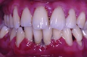 Periodontitis