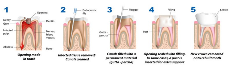 Tooth Filling